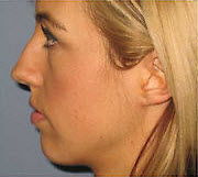 Before Image: Patient # 97414 - front