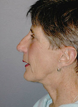 After Image: Patient # 62163 - front