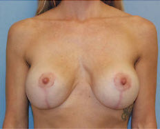 After Image: Patient # 27241 - front