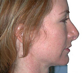 After Image: Patient # 89397 - front