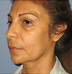 After Image: Patient # 15839 - front