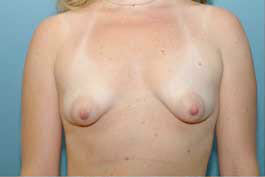 Before Image: Patient # 28080 - front