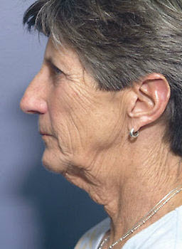 Before Image: Patient # 62163 - front