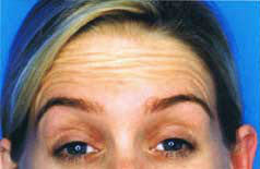Before Image: Patient # 59963 - front