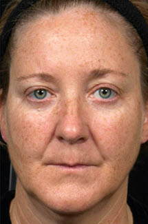 Before Image: Patient # 39111 - front