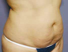 Before Image: Patient # 65074 - front