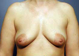 Before Image: Patient # 34333 - front