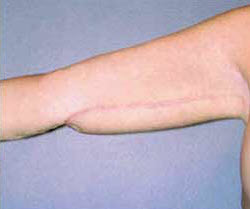 After Image: Patient # 92542 - front