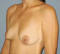 Before Image: Patient # 37240 - front