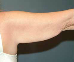Before Image: Patient # 78463 - front