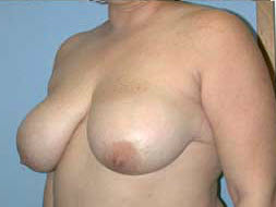 Before Image: Patient # 47627 - front