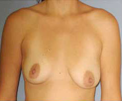 Before Image: Patient # 37240 - front