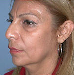 Before Image: Patient # 15839 - front