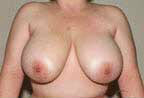 Before Image: Patient # 62107 - front