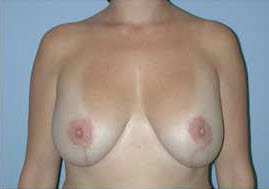 After Image: Patient # 24878 - front