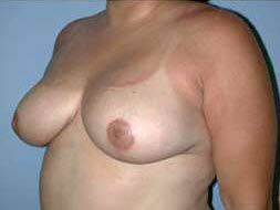 After Image: Patient # 47627 - front