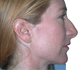 Before Image: Patient # 89397 - front