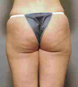 Before Image: Patient # 93344 - front
