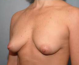 Before Image: Patient # 54253 - front