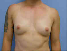 Before Image: Patient # 87448 - front