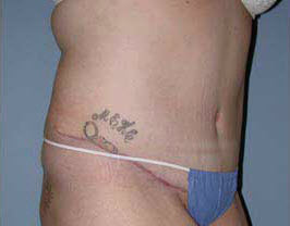 After Image: Patient # 30777 - front