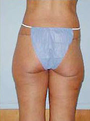 After Image: Patient # 58183 - front