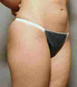 Before Image: Patient # 56767 - front