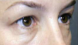 Before Image: Patient # 33507 - 