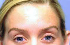 After Image: Patient # 59963 - front