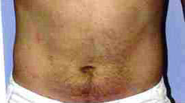 After Image: Patient # 56482 - front