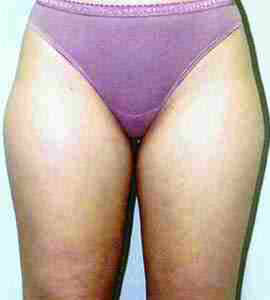 Before Image: Patient # 22368 - front