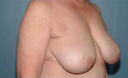 Before Image: Patient # 82697 - front