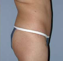 After Image: Patient # 99846 - front