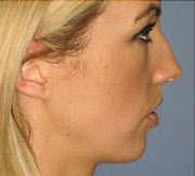 Before Image: Patient # 97414 - front