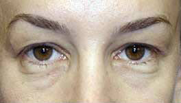 Before Image: Patient # 33507 - 