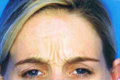 Before Image: Patient # 59963 - front