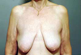 Before Image: Patient # 71625 - front