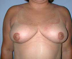 After Image: Patient # 47627 - front