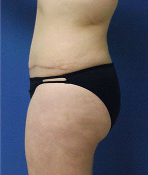 After Image: Patient # 28534 - front