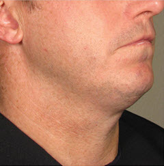 Before Image: Patient # 21638 - 