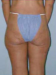 Before Image: Patient # 58183 - front