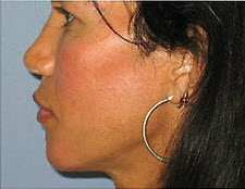 After Image: Patient # 97273 - front