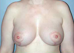 After Image: Patient # 34333 - front