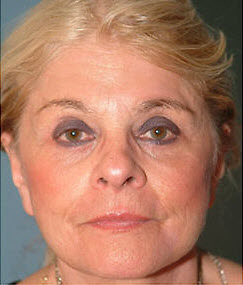 After Image: Patient # 53232 - front