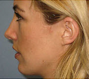After Image: Patient # 97414 - front