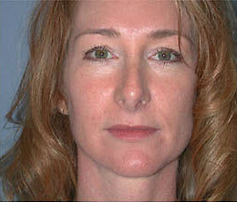 After Image: Patient # 13120 - front