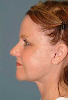 After Image: Patient # 64128 - front