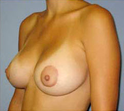 After Image: Patient # 37240 - front