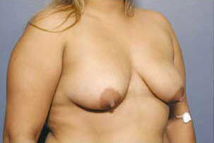 Before Image: Patient # 45931 - front