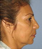 After Image: Patient # 15839 - front